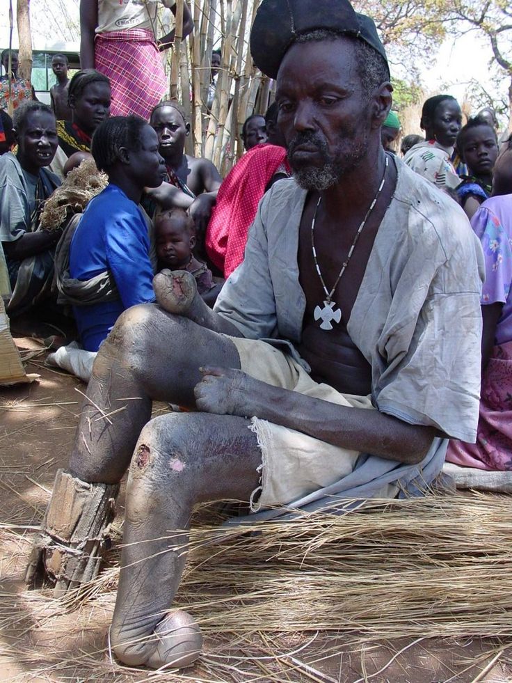 Lazarus Fonds Leprosy